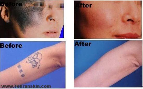 همه آنچه باید در مورد لیزر کیو سوئیچ بدانید