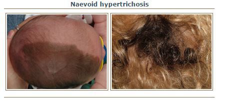 هیپر تریکوز نائوید