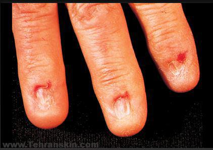 تشخیص و درمان لیکن پلان