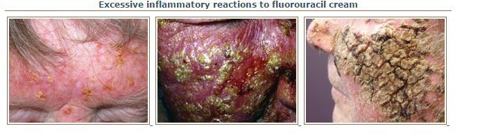 کرم موضعی فلوروراسیل