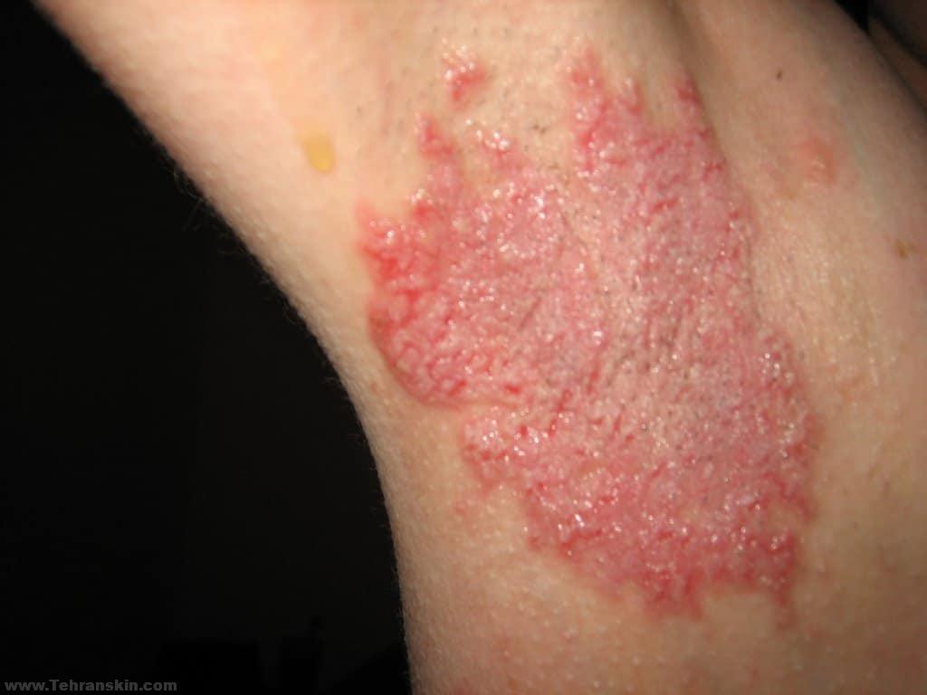 بیماری هایلی- هایلی