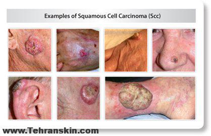 کارسینوم سلول سنگفرشی