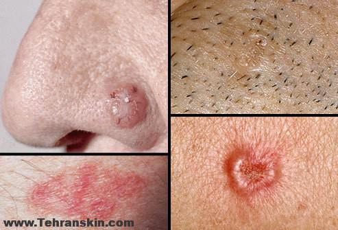 کارسینوم سلول بازال