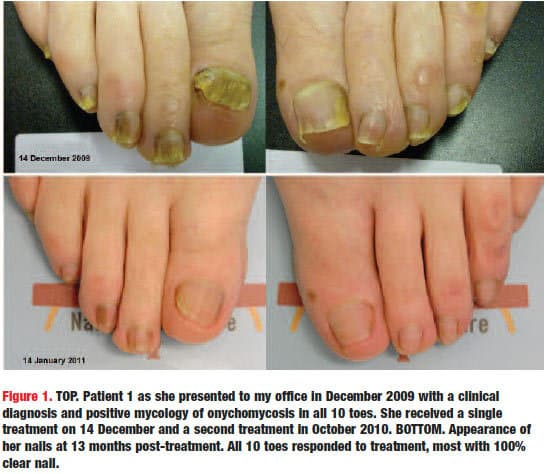 داروی تربینافین