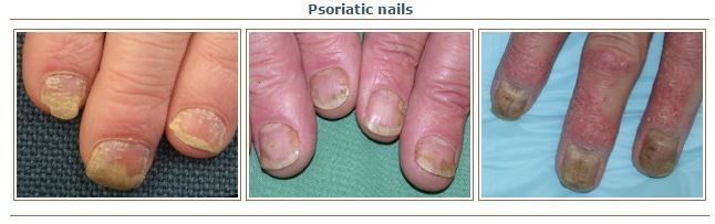پسوریازیس ناخن