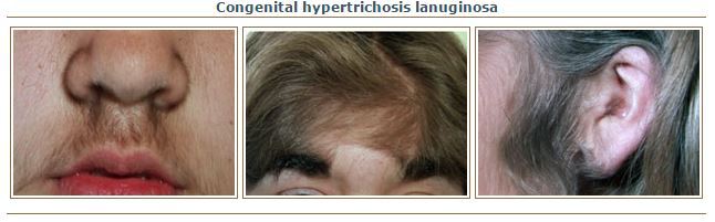 هیپرتریکوز مادرزادی لانوگو