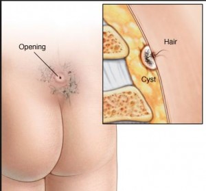 سینوس پایلونیدال