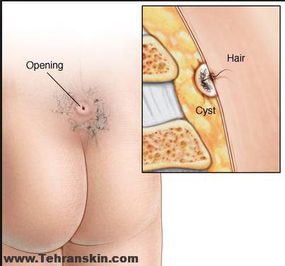 سینوس پایلونیدال- pilonidal sinus