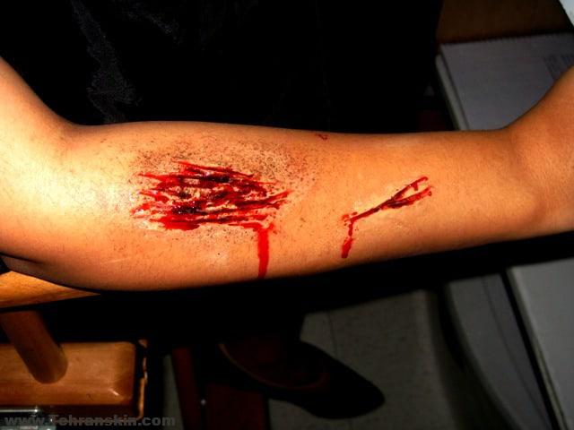 مراقبت های اولیه لازم در برخورد با زخمها و بریدگی ها