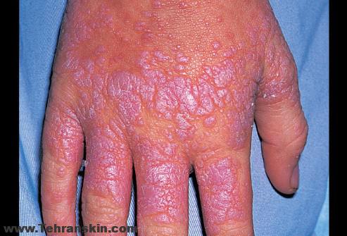 بیماری لیکن پلان- lichen planus