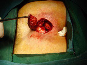 سینوس پایلونیدال