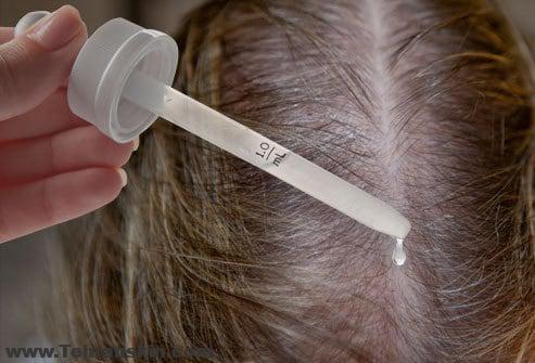 دلایل ریزش مو در زنان چیست؟ دلایل شوره سر و ریزش مو در مردان | کاشت مو