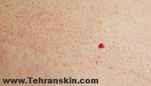 آنژیوم گیلاسی