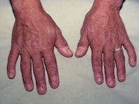 آکرومگالی 2