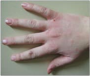 درماتیت تماسی