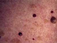 Haemangioma arising in adults