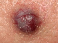 آنژیوم گیلاسی 2