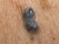 آنژیوم گیلاسی 3