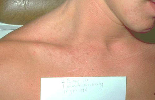 بیماری داریر سفید