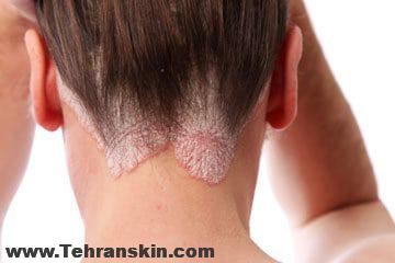 ضایعات پشت گردن