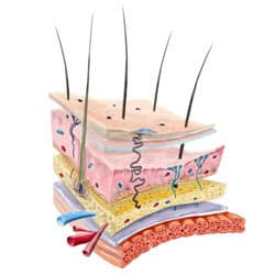ایکتیوز لاملار (Lamellar Ichthyosis)  