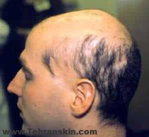 آلوپسیا آره آتا تشخیص، درمان، و پیامد