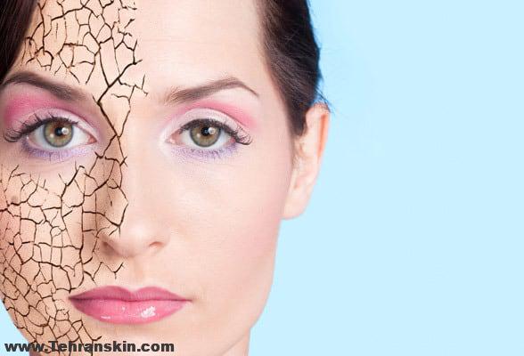 خشکی پوست و سؤالات رأیج آن (1)