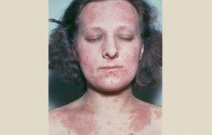 درماتیت آتوپیک (اگزما) بزرگسالان