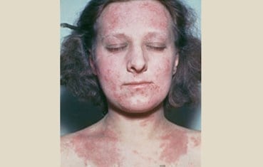 درماتیت آتوپیک (اگزما)  بزرگسالان