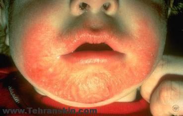 درماتیت آتوپیک (اگزما)