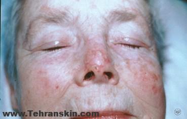 سرطان سلول-پایه‌ای پوست