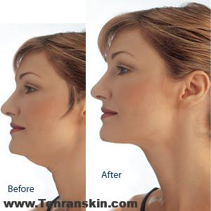 بوسیدن سقف بهترین راه برای از بین بردن غبغب!