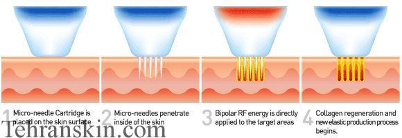 آر اف سوزنی