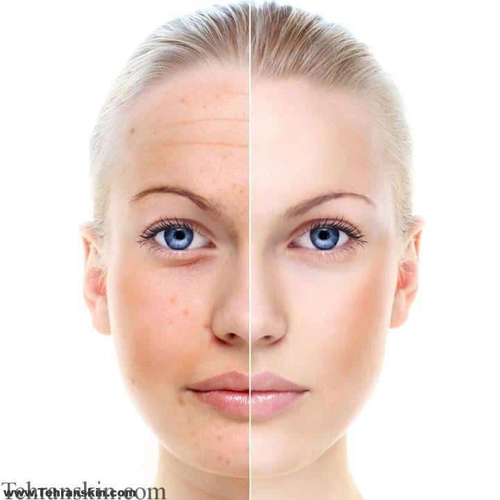 آر اف با سوزن