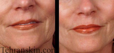 جوانسازی اطراف دهان و صورت با روش FMR