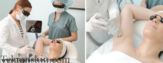 لیزر موهای زائد با دستگاه دیود