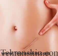 درمانهای رایج اسکار زخم