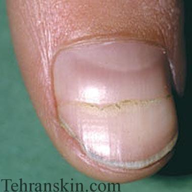 اختلال افقی