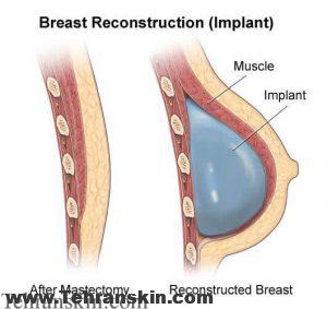 انواع عمل های زیبایی سینه | بزرگ کردن ، کوچک کردن ، لیفت ، بازسازی سینه