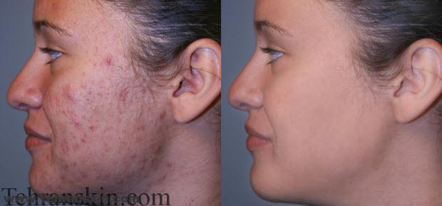 جای زخم و جوش