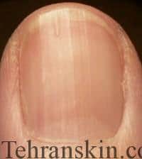 رشته رشته شدن ناخن