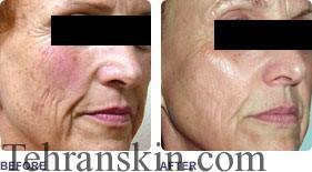 لیزر درمانی جهت از بین بردن چین و چروک