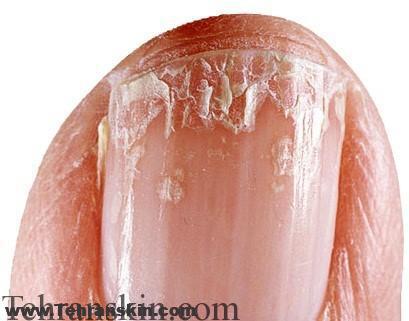 ناخن ضعیف، شکننده، و خرد