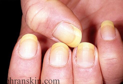 ناخن های زرد