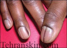 نوارهای تیره عمودی