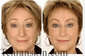 سفت کردن پوست