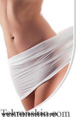 لیزر موهای زائد ناحیه بیکینی