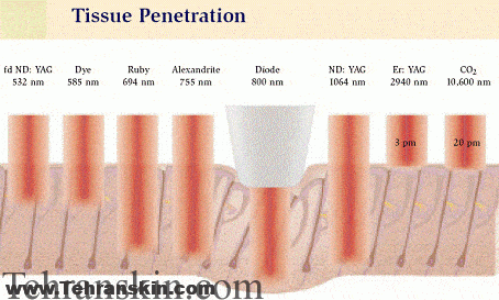مقایسه عمق نفوذ برخی انواع لیزر