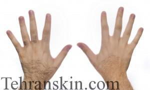 لیزر و اختلالات هورمونی