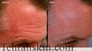 چروک پیشانی